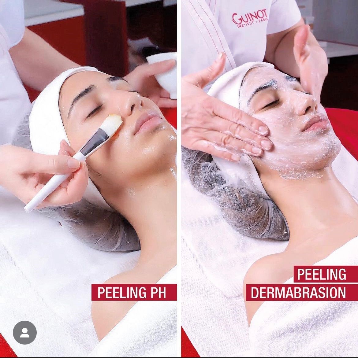 Hydra Peeling